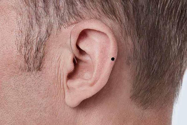 Nốt ruồi ở tai có ý nghĩa gì?